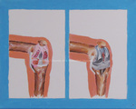 Knee Replacement by Ishwarya S. Mamidi